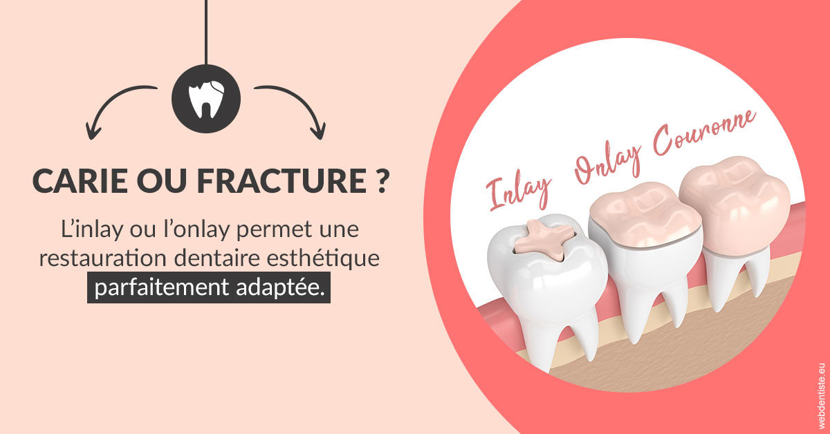 https://selarl-cabinet-dentaire-la-passerelle.chirurgiens-dentistes.fr/T2 2023 - Carie ou fracture 2