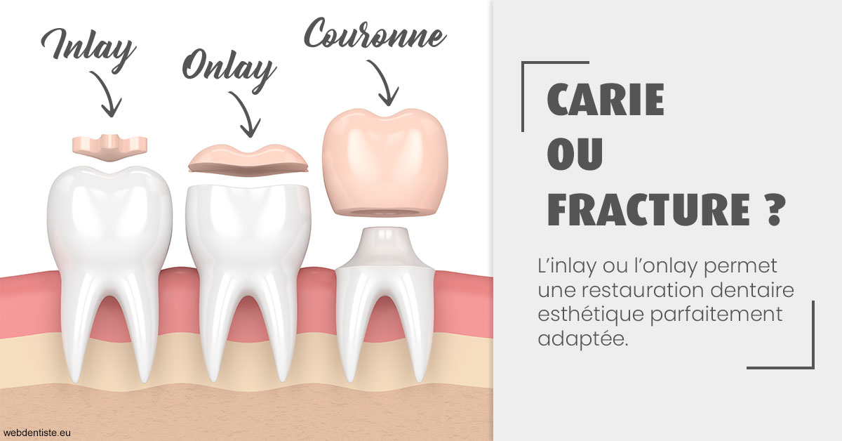 https://selarl-cabinet-dentaire-la-passerelle.chirurgiens-dentistes.fr/T2 2023 - Carie ou fracture 1