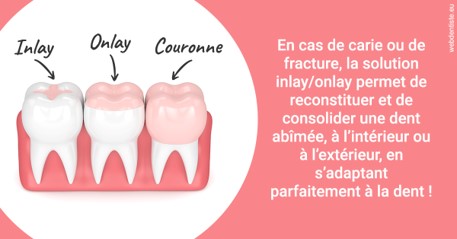 https://selarl-cabinet-dentaire-la-passerelle.chirurgiens-dentistes.fr/L'INLAY ou l'ONLAY 2