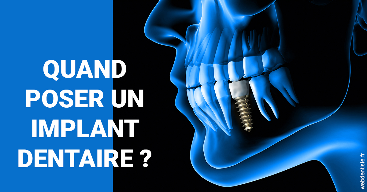 https://selarl-cabinet-dentaire-la-passerelle.chirurgiens-dentistes.fr/Les implants 1