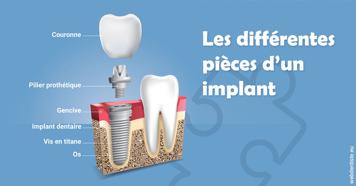 https://selarl-cabinet-dentaire-la-passerelle.chirurgiens-dentistes.fr/Les différentes pièces d’un implant 1